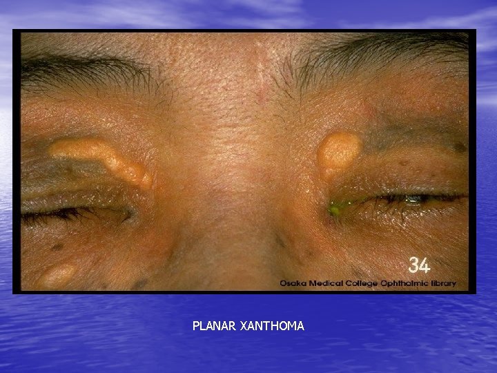 PLANAR XANTHOMA 