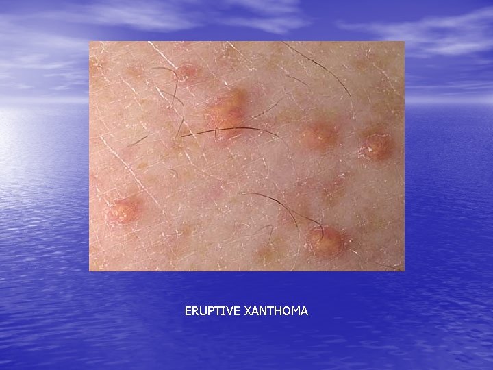 ERUPTIVE XANTHOMA 