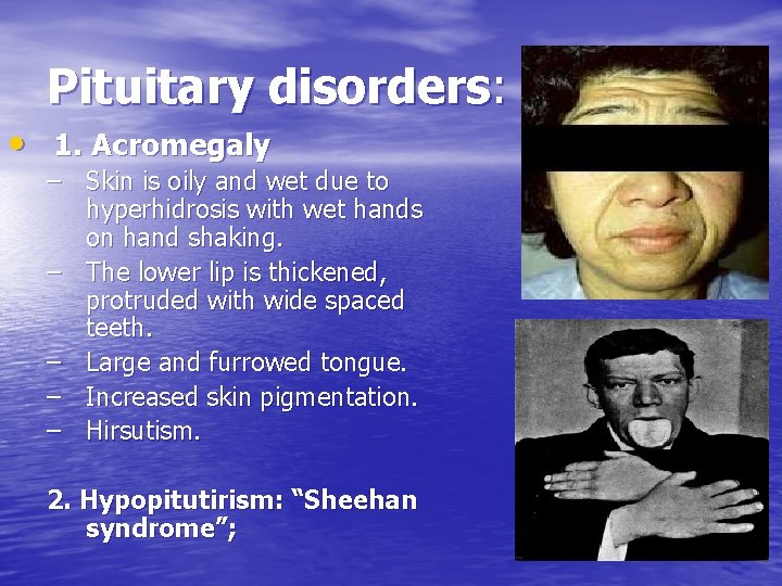 Pituitary disorders: • 1. Acromegaly – Skin is oily and wet due to hyperhidrosis