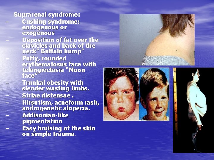 – – – – Suprarenal syndrome: Cushing syndrome: endogenous or exogenous Deposition of fat