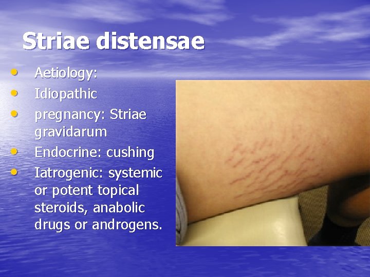Striae distensae • • • Aetiology: Idiopathic pregnancy: Striae gravidarum Endocrine: cushing Iatrogenic: systemic