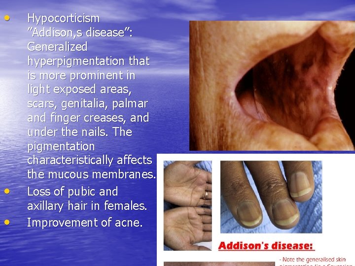  • • • Hypocorticism ”Addison, s disease”: Generalized hyperpigmentation that is more prominent