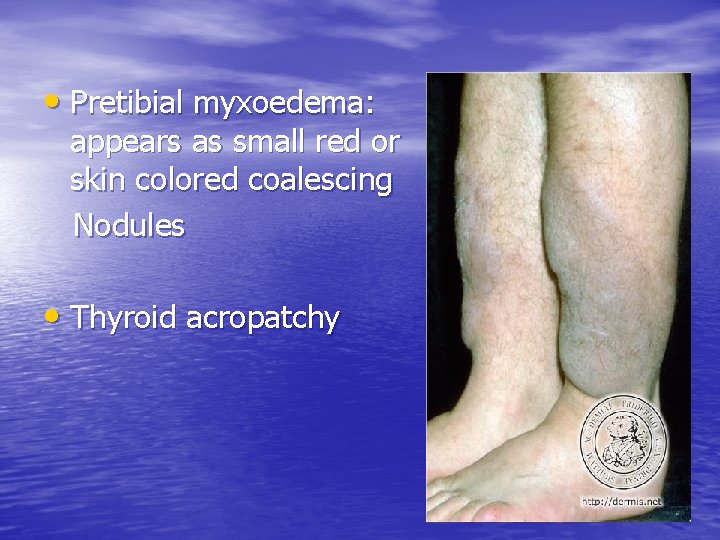  • Pretibial myxoedema: appears as small red or skin colored coalescing Nodules •