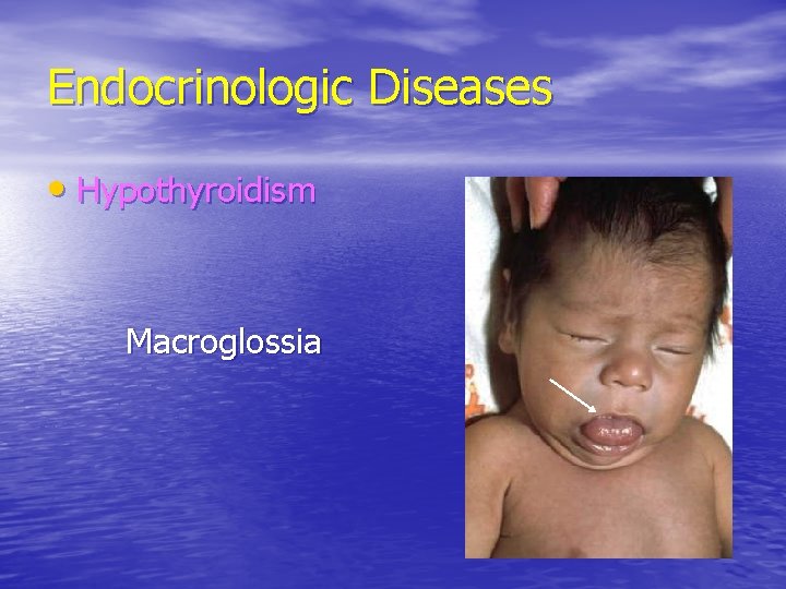 Endocrinologic Diseases • Hypothyroidism Macroglossia 