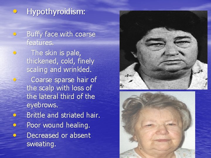  • Hypothyroidism: • • • Buffy face with coarse features. The skin is