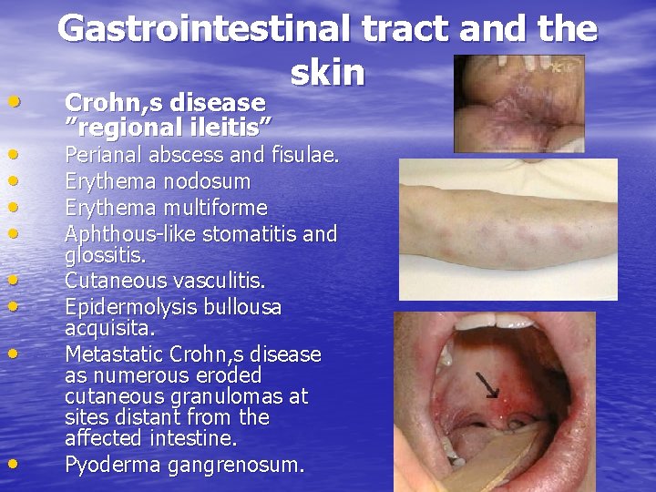  • • • Gastrointestinal tract and the skin Crohn, s disease ”regional ileitis”