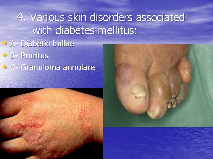 4. Various skin disorders associated with diabetes mellitus: • A- Diabetic bullae • B-