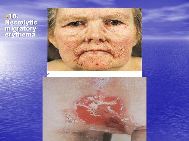  • 18. Necrolytic migratory erythema 