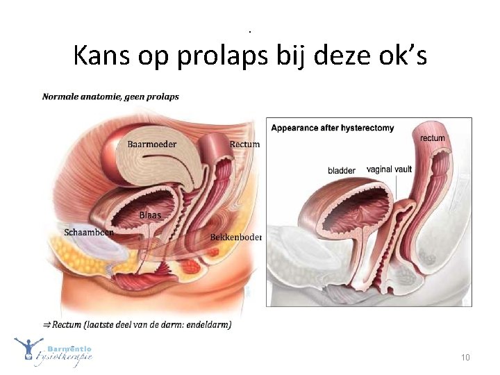 . Kans op prolaps bij deze ok’s 10 