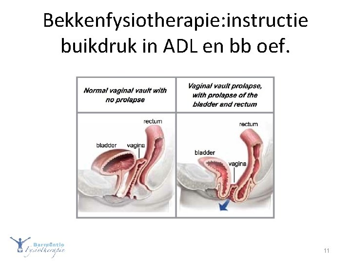 Bekkenfysiotherapie: instructie buikdruk in ADL en bb oef. 11 