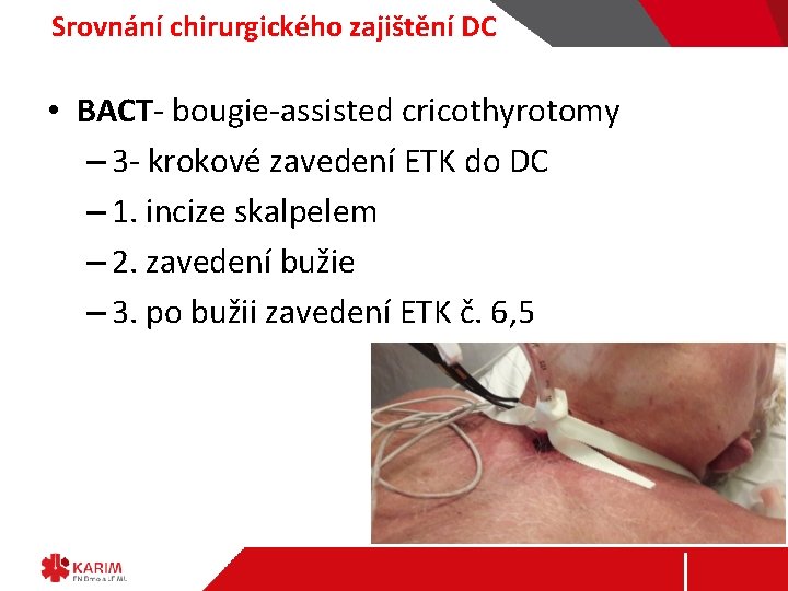 Srovnání chirurgického zajištění DC • BACT- bougie-assisted cricothyrotomy – 3 - krokové zavedení ETK