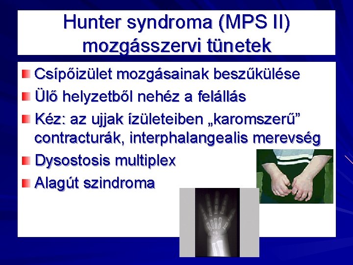 Hunter syndroma (MPS II) mozgásszervi tünetek Csípőizület mozgásainak beszűkülése Ülő helyzetből nehéz a felállás