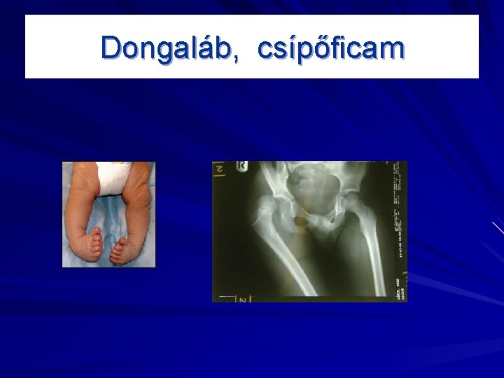 Dongaláb, csípőficam 