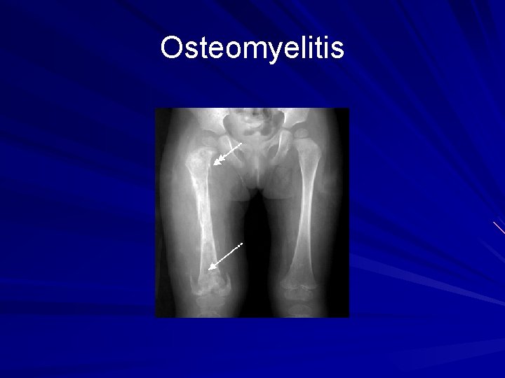 Osteomyelitis 