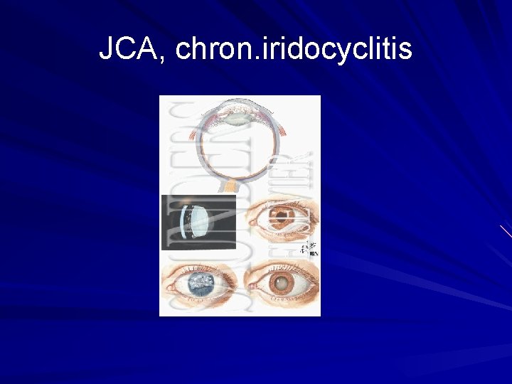 JCA, chron. iridocyclitis 