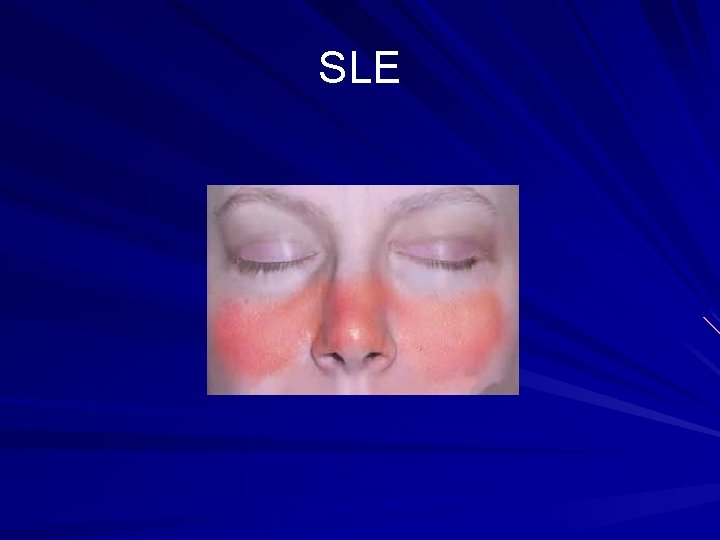 SLE 