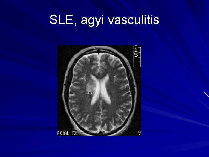 SLE, agyi vasculitis 
