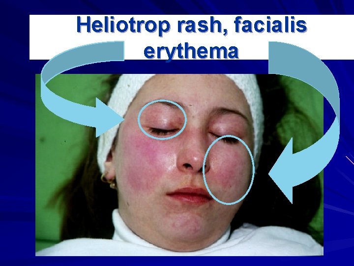 Heliotrop rash, facialis erythema 