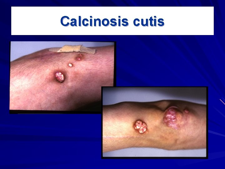 Calcinosis cutis 