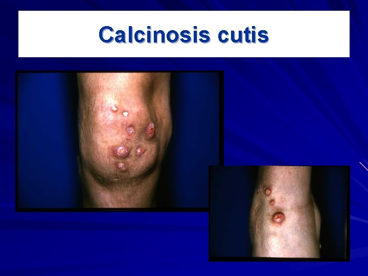 Calcinosis cutis 