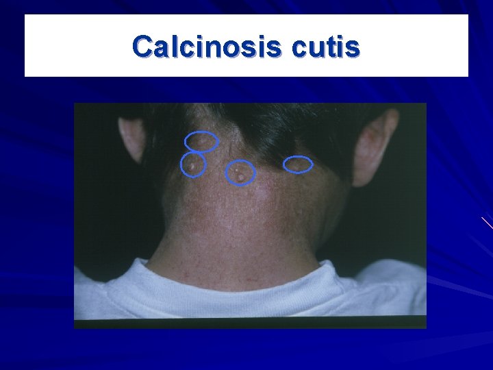 Calcinosis cutis 