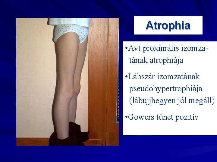 Atrophia • Avt proximális izomzatának atrophiája • Lábszár izomzatának pseudohypertrophiája (lábujjhegyen jól megáll) •