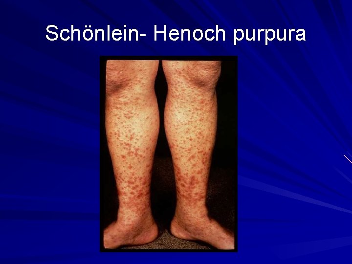 Schönlein- Henoch purpura 