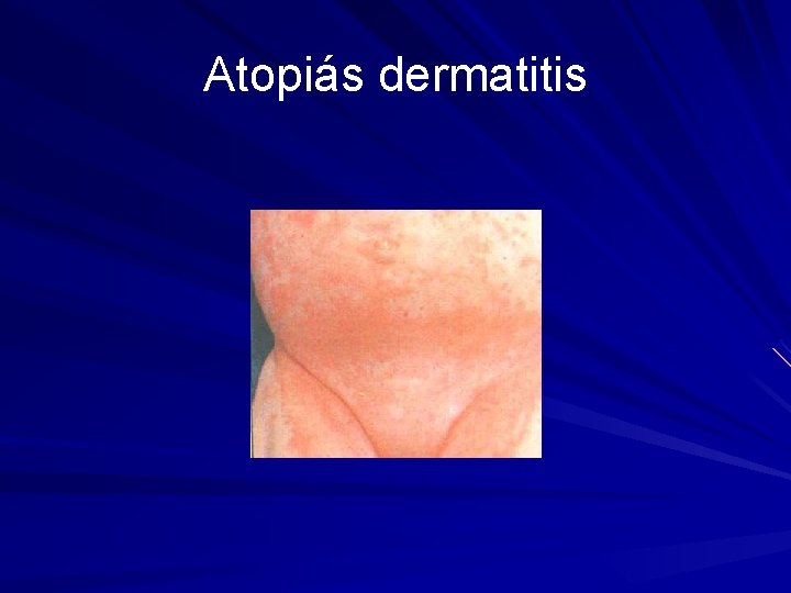 Atopiás dermatitis 