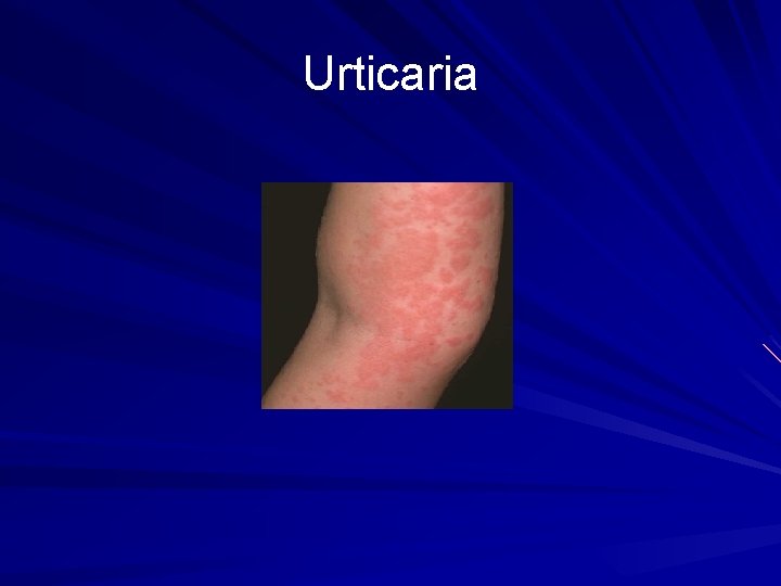 Urticaria 