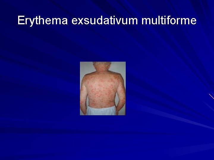 Erythema exsudativum multiforme 