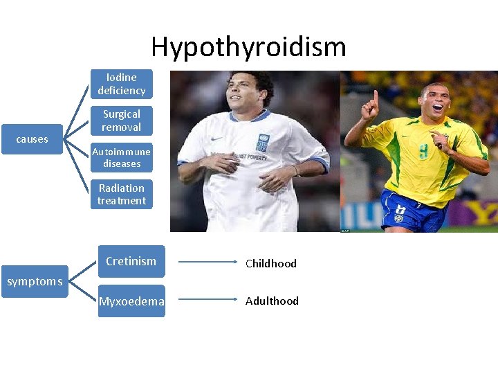 Hypothyroidism Iodine deficiency causes Surgical removal Autoimmune diseases Radiation treatment Cretinism Childhood Myxoedema Adulthood