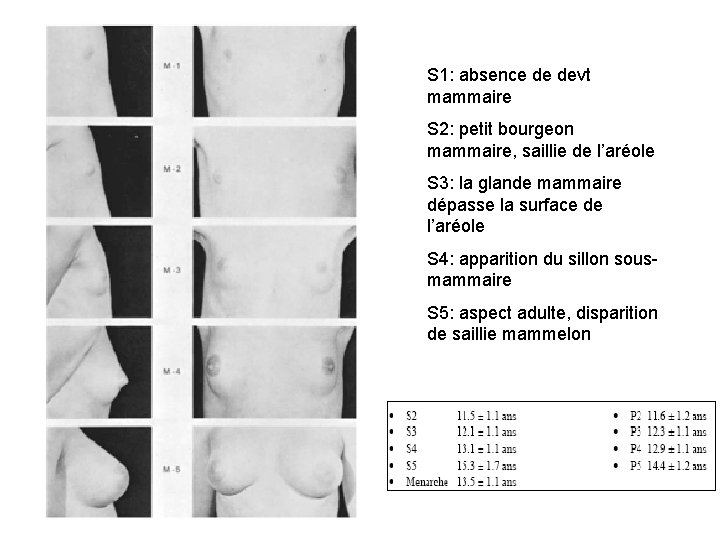 S 1: absence de devt mammaire S 2: petit bourgeon mammaire, saillie de l’aréole