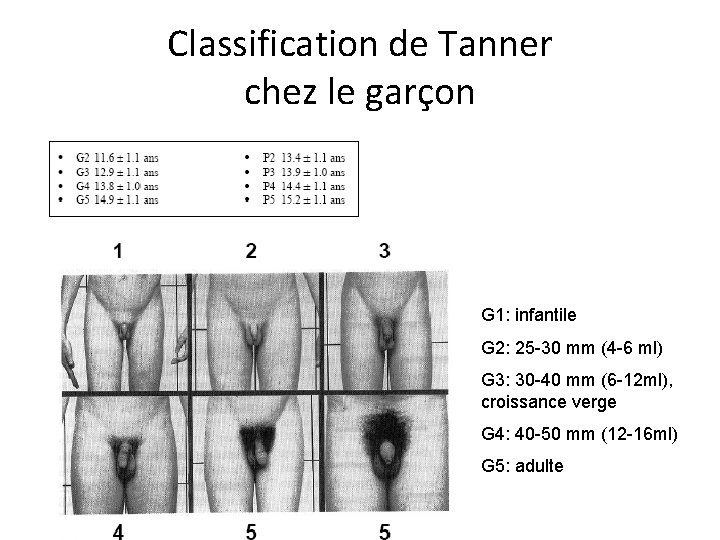 Classification de Tanner chez le garçon G 1: infantile G 2: 25 -30 mm