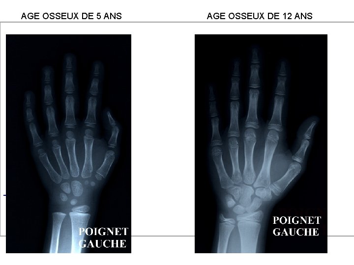 AGE OSSEUX DE 5 ANS AGE OSSEUX DE 12 ANS 