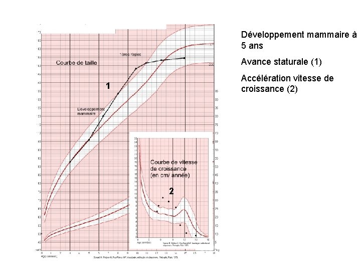 Développement mammaire à 5 ans Avance staturale (1) Accélération vitesse de croissance (2) 1