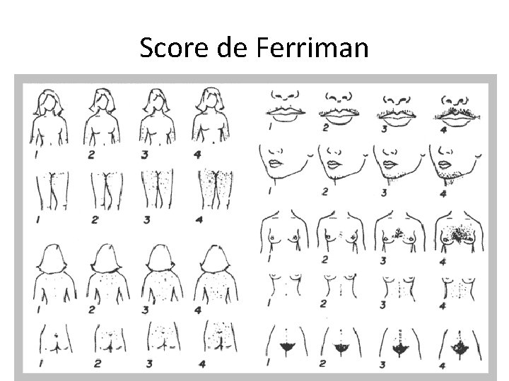 Score de Ferriman 
