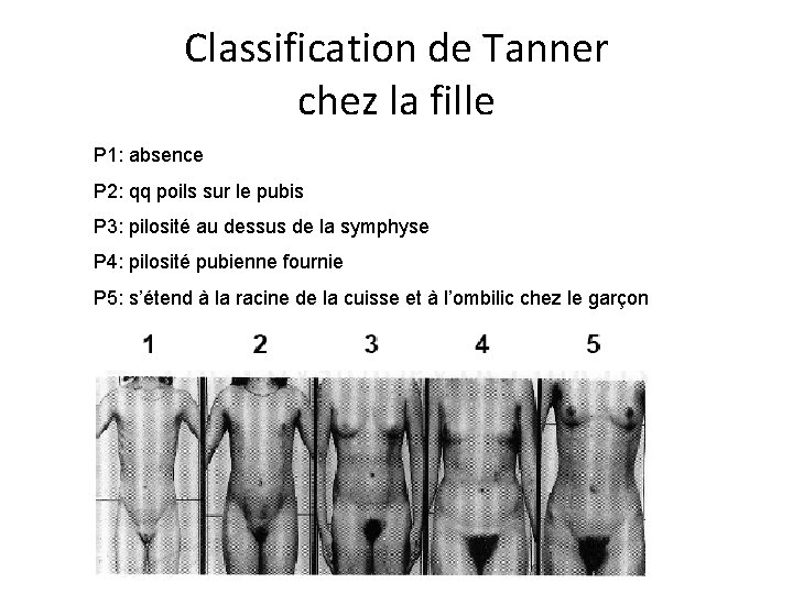 Classification de Tanner chez la fille P 1: absence P 2: qq poils sur