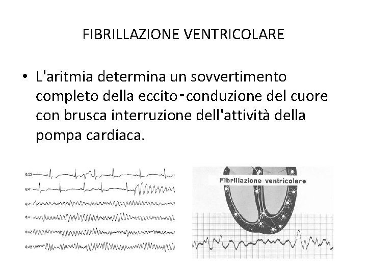 FIBRILLAZIONE VENTRICOLARE • L'aritmia determina un sovvertimento completo della eccito‑conduzione del cuore con brusca