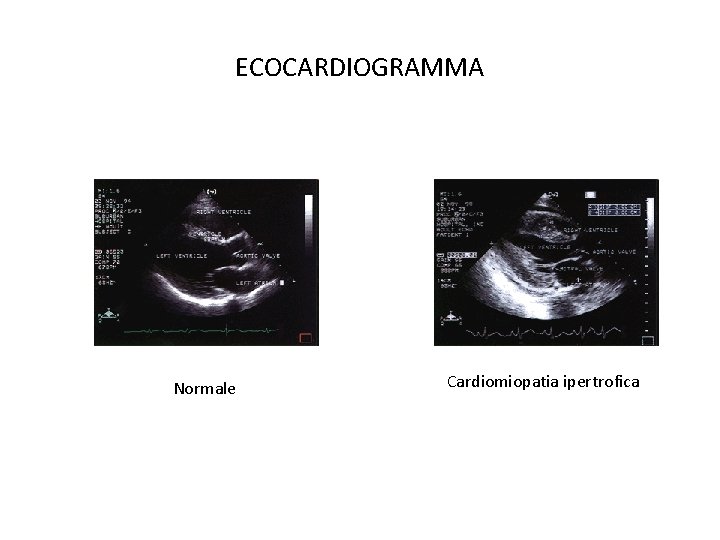 ECOCARDIOGRAMMA Normale Cardiomiopatia ipertrofica 