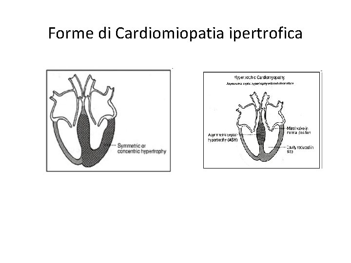 Forme di Cardiomiopatia ipertrofica 