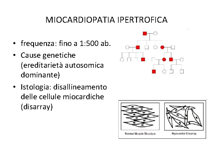 MIOCARDIOPATIA IPERTROFICA • frequenza: fino a 1: 500 ab. • Cause genetiche (ereditarietà autosomica