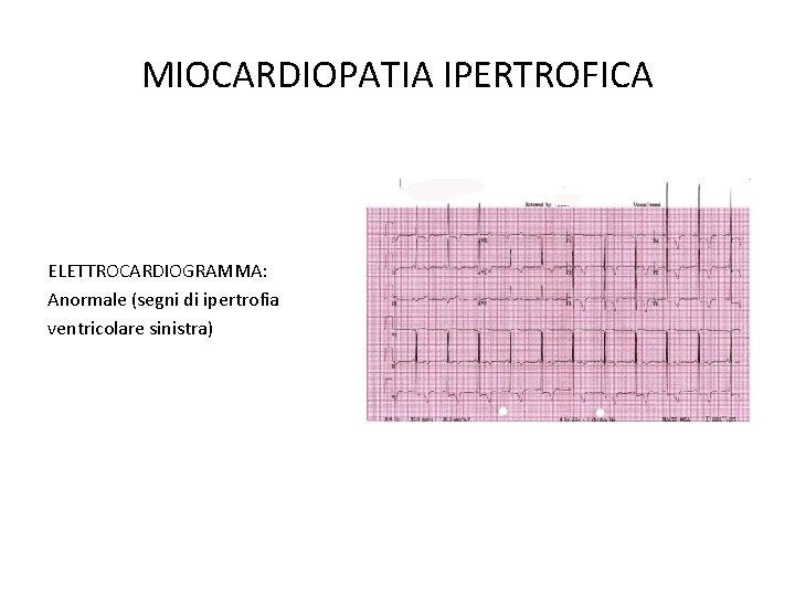 MIOCARDIOPATIA IPERTROFICA ELETTROCARDIOGRAMMA: Anormale (segni di ipertrofia ventricolare sinistra) 