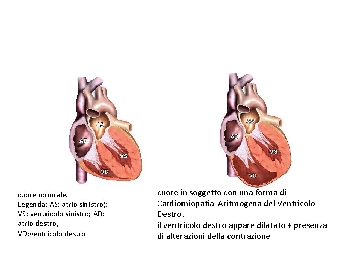 cuore normale. Legenda: AS: atrio sinistro); VS: ventricolo sinistro; AD: atrio destro, VD: ventricolo