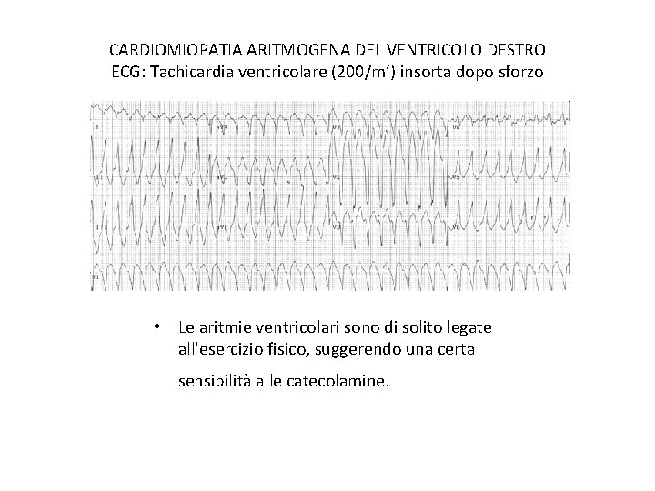 CARDIOMIOPATIA ARITMOGENA DEL VENTRICOLO DESTRO ECG: Tachicardia ventricolare (200/m’) insorta dopo sforzo • Le