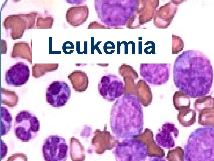 Leukemia 