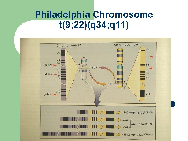 Philadelphia Chromosome t(9; 22)(q 34; q 11) 
