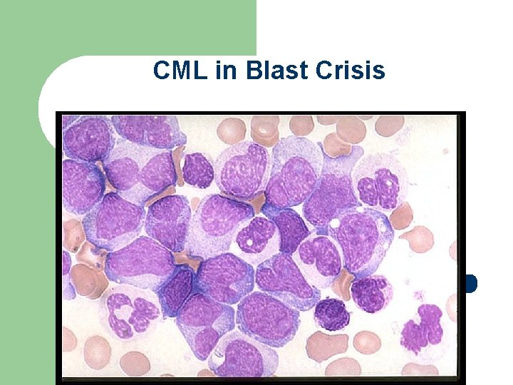 CML in Blast Crisis 