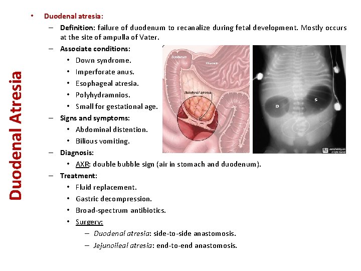 Duodenal Atresia • Duodenal atresia: – Definition: failure of duodenum to recanalize during fetal