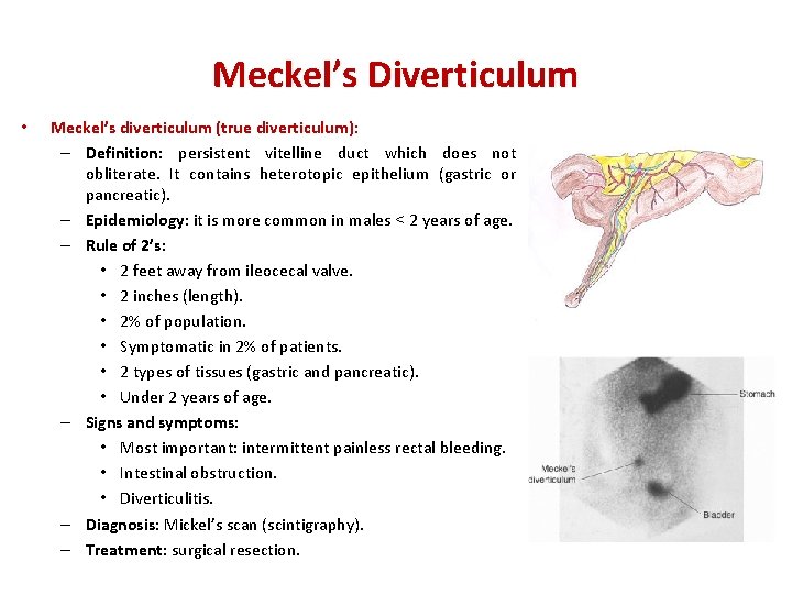 Meckel’s Diverticulum • Meckel’s diverticulum (true diverticulum): – Definition: persistent vitelline duct which does