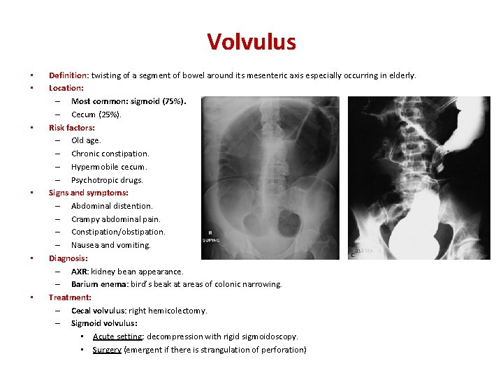 Volvulus • • • Definition: Definition twisting of a segment of bowel around its